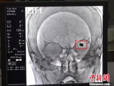 九旬老人腦部長“巨型”動脈瘤 醫生拆除“不定時炸彈”