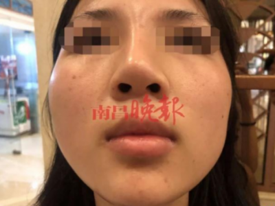 南昌禾麗整形醫院把我鼻子整歪了 記者介入協調才同意免費修復