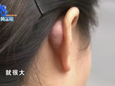 杭州千晴整形醫(yī)院隆鼻后耳后根長(zhǎng)了個(gè)包 鼻孔也一大一小