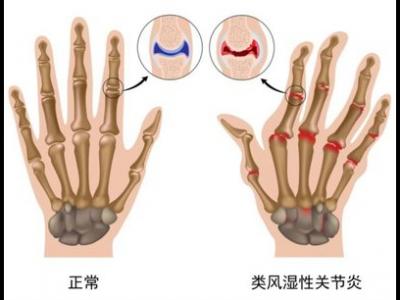 類(lèi)風(fēng)濕關(guān)節(jié)炎高發(fā)人群存在著哪些特性
