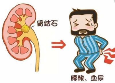 腎結(jié)石疼痛難忍這個的飲食原則有助于排石
