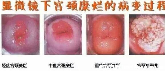 宮頸糜爛一二三度圖片，真實對比照片(小心是宮頸癌前兆)
