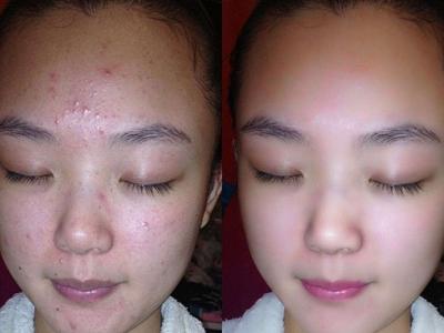 女性長膿包型痤瘡怎么治理，紅腫膿皰護理不當容易留痘疤
