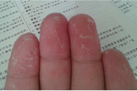 手指脫皮的四個原因，教你快速恢復方法治療手脫皮