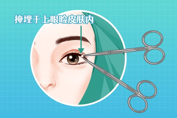 雙眼皮太寬了怎么修復