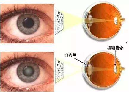都是視力下降！白內障、老花眼有何不同？