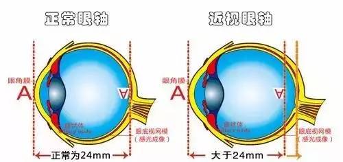 弱視是怎么形成的？它與近視有哪些區(qū)別？