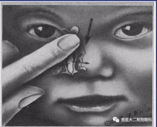 先天性淚道阻塞如何進(jìn)行按摩? 先天性淚道阻塞如何進(jìn)行按摩?