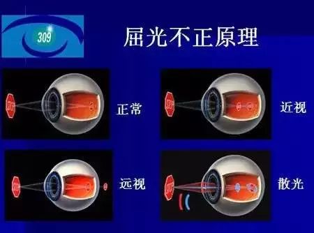 弱視是怎么形成的？它與近視有哪些區(qū)別？