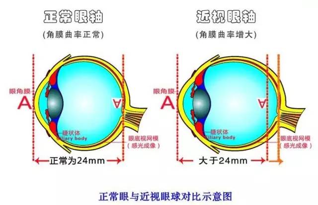 孩子近視度數猛漲？近視防控小心誤區！