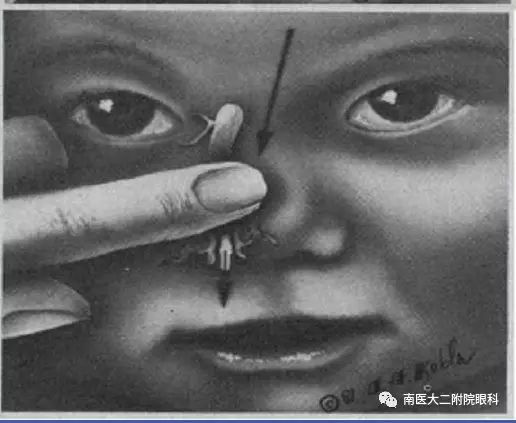 先天性淚道阻塞如何進(jìn)行按摩? 先天性淚道阻塞如何進(jìn)行按摩?