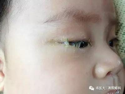 淚道阻塞的癥狀和危害有哪些？