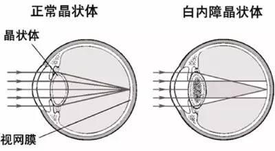 你不得不知的白內(nèi)障幾大問題
