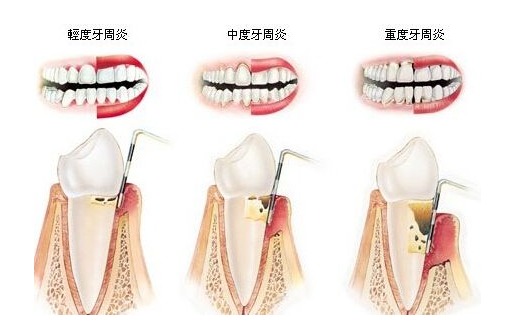 為什么會有牙周??？牙周病的中醫治療和保養方法